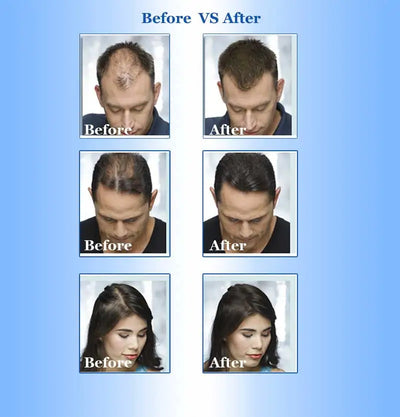 Ginger Hair Growth Essence Yuda Pilatory Stop Hair Loss Fast Hair Growth Products for Men and Woman  Grow Restoration 30ml