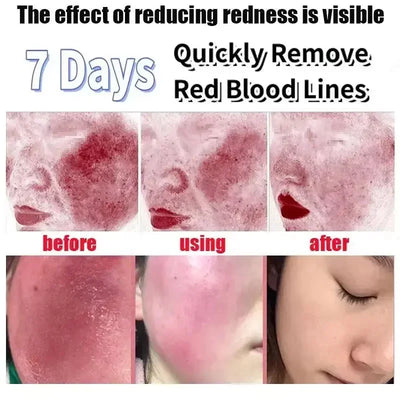 Fast Repair Facial Redness Essential oil Soothing Red Blood Rosacea Improve Sensitive Skin Dryness Moisturizing Korean Cosmetics