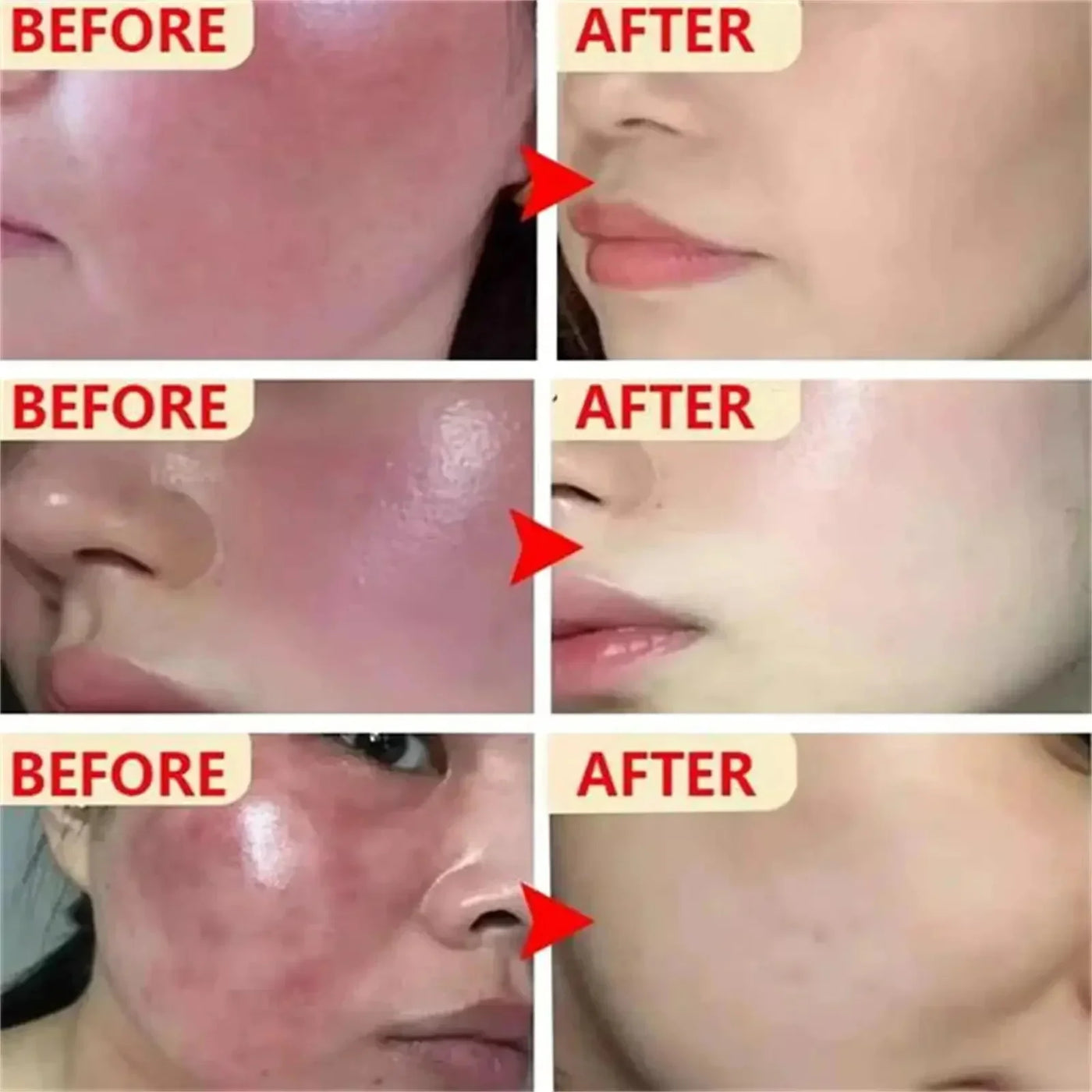 Fast Repair Facial Redness Essential oil Soothing Red Blood Rosacea Improve Sensitive Skin Dryness Moisturizing Korean Cosmetics