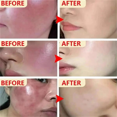 Fast Repair Facial Redness Essential oil Soothing Red Blood Rosacea Improve Sensitive Skin Dryness Moisturizing Korean Cosmetics