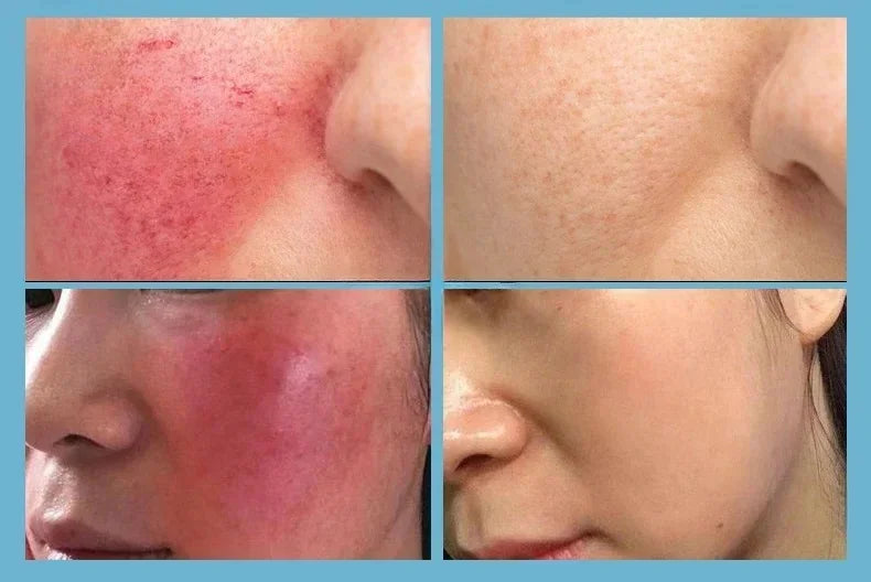 7 Day Repair Redness Serum Sooth Itching Sensitive Skin Improve Rosacea Shrink Pore Smooth Nourish Facial Skin Korean Cosmetics