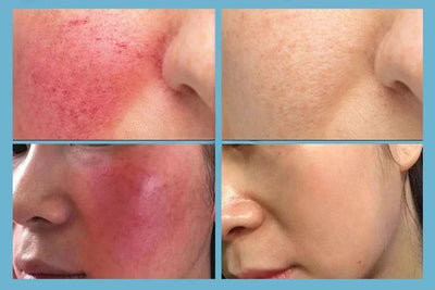 7 Day Repair Redness Serum Sooth Itching Sensitive Skin Improve Rosacea Shrink Pore Smooth Nourish Facial Skin Korean Cosmetics