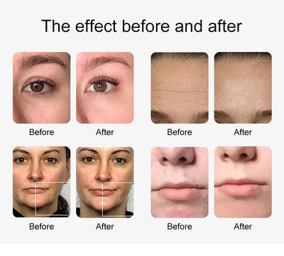 AOKO New10IN 1 Hydro Dermabrasion Aqua Peeling Ultrasound Facial Care Oxygen Injection Skin Rejuvenation Whiting Beauty Machine