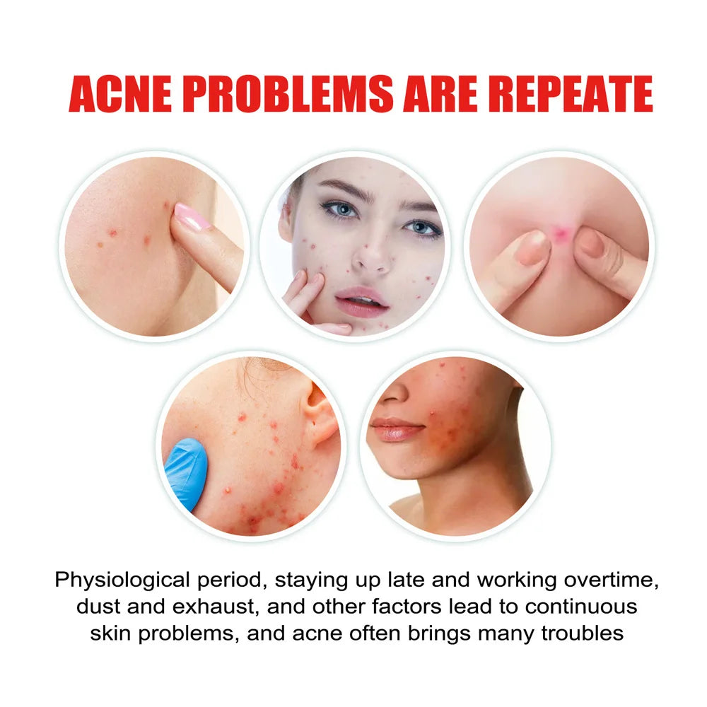 Repair Acne Patch Facial Skin Care Fade Blemishes Pimple Marks Closed Acne Blemishes Cover Acne Pimple Repair Patch