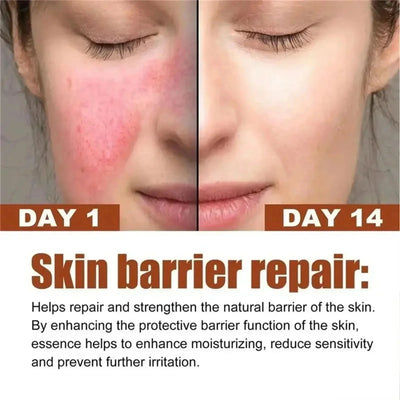 Fast Repair Facial Redness Essential oil Soothing Red Blood Rosacea Improve Sensitive Skin Dryness Moisturizing Korean Cosmetics