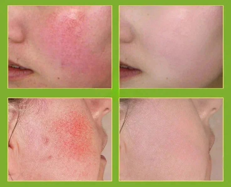 7 Day Repair Redness Serum Sooth Itching Sensitive Skin Improve Rosacea Shrink Pore Smooth Nourish Facial Skin Korean Cosmetics