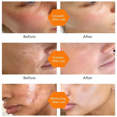 Vitamin C Whitening Serum Remove Freckles Dark Spots Face Essence Fade Melasma Melanin Brighten Repair Dull Skin Care Cosmetics