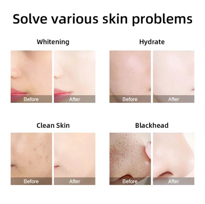 Hydro Water Jet Peel Hydrodermabrasion Machine 6 in 1 Facial Dermabrasion Hydra Skin Whitening Device Facial Skin Care Machine