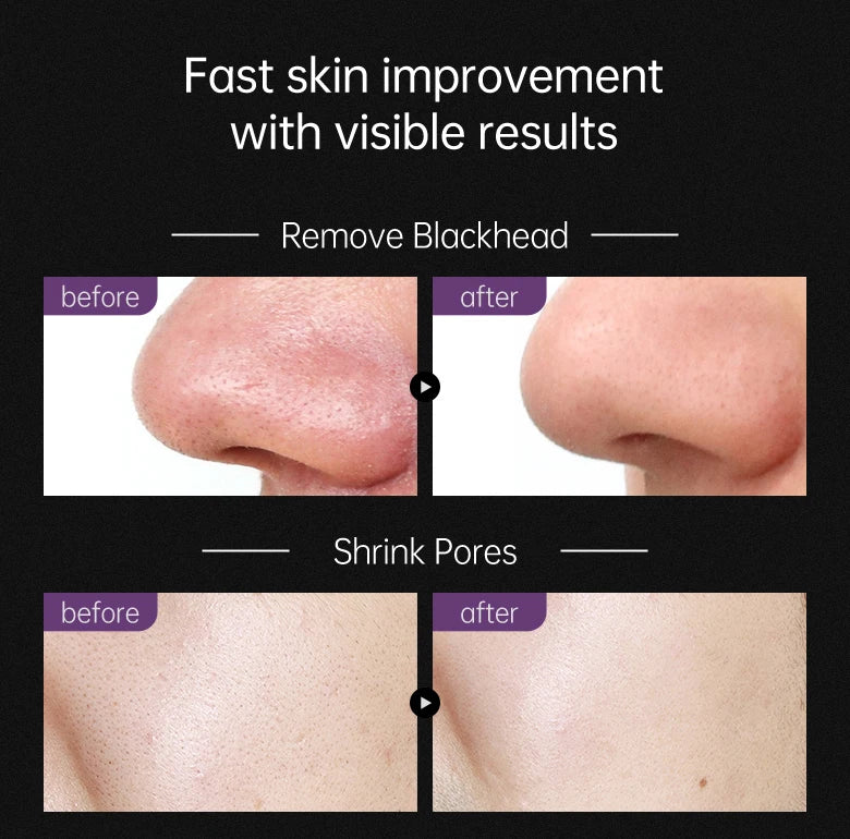 Black Head Remover Face Mask Bamboo Charcoal Black Dot T-zone Deep Cleaning for Women Men Blackhead Facial Skin Care Products