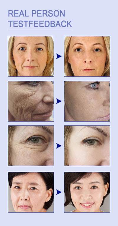 20 ʏᴇᴀʀs ʏᴏᴜɴɢᴇʀ! Aɴᴛɪ-ᴡʀɪɴᴋʟᴇ, ғɪʀᴍɪɴɢ, ʟɪɢʜᴛ ʟɪɴᴇs ʀᴇᴘᴀɪʀ