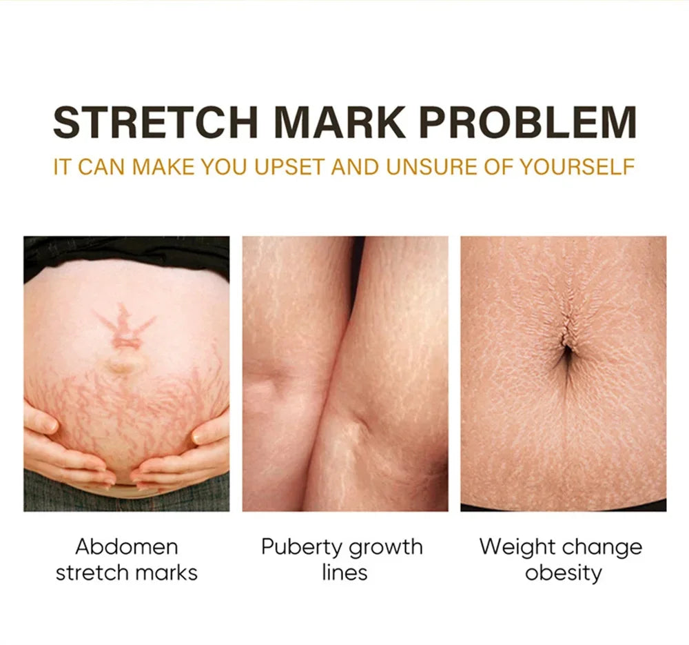 Stretch Mark Removal Oil Removes Postpartum Pregnant Women Scar Repair Obesity Stretch Mark Anti-Aging Firming Serum Skin Care