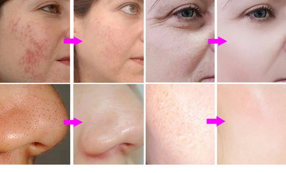 New Style Diamond Microdermabrasion Dermabrasion Machine Water Spray Exfoliation Beauty Machine Wrinkle Face Peeling Machine