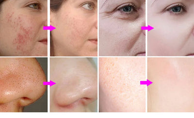 New Style Diamond Microdermabrasion Dermabrasion Machine Water Spray Exfoliation Beauty Machine Wrinkle Face Peeling Machine