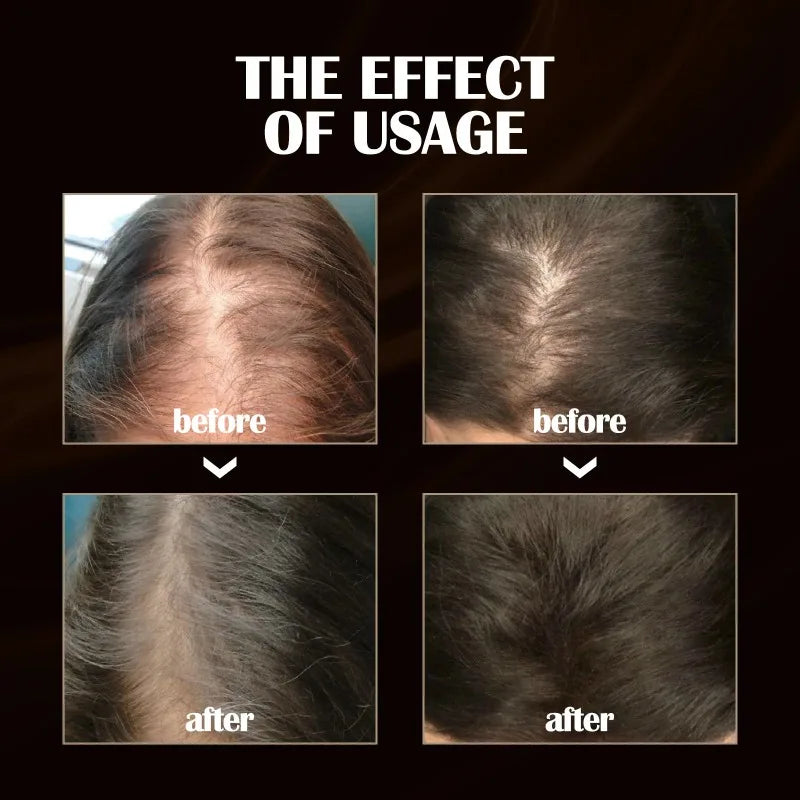 Hair Growth Serum Spray Ginger Anti Hair Loss Treatment Products Repair Nourish hair Roots Fast Regrowth Men Women