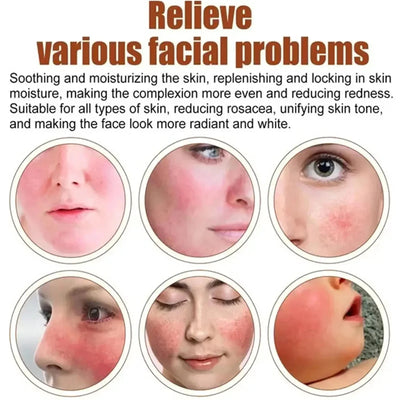 Fast Repair Facial Redness Essential oil Soothing Red Blood Rosacea Improve Sensitive Skin Dryness Moisturizing Korean Cosmetics
