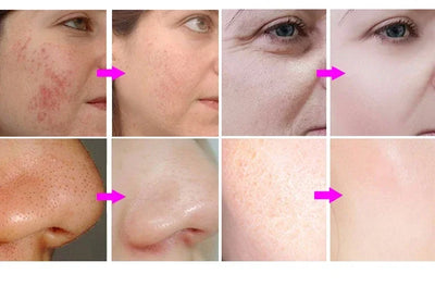 3 in 1 Hydrofacial Beauty Machine Oxygen Skin Rejuvenation Facial Tightening Machine For Skin Whitening CO2 Bubble+RF+Ultrasound