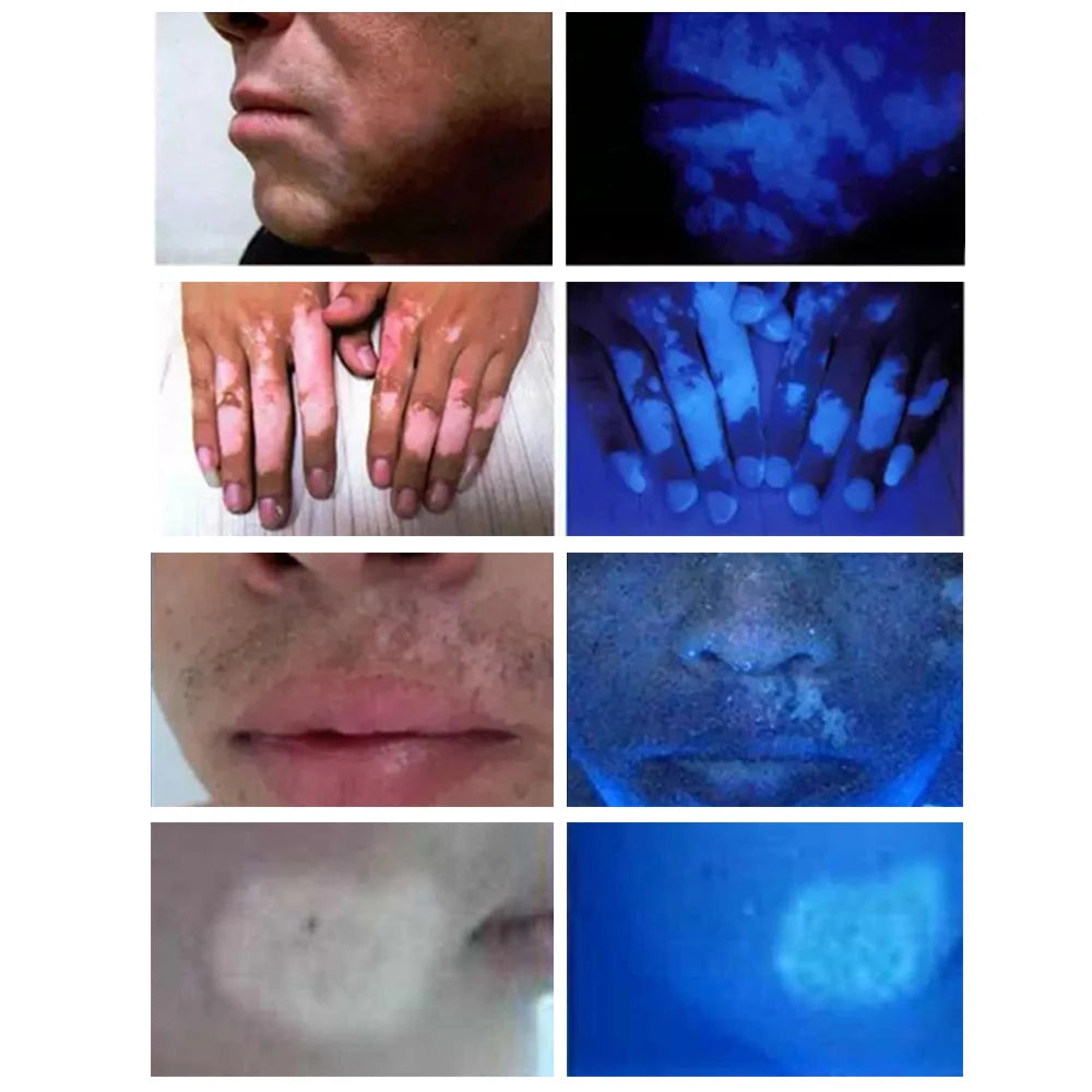 UV Analyzer Wood Lamp Facial Skin Testing Examination Magnifying Appraisal Greyness Tinea Machine Beauty SPA Salon Equipment