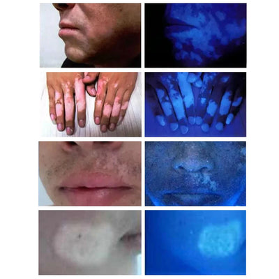 UV Analyzer Wood Lamp Facial Skin Testing Examination Magnifying Appraisal Greyness Tinea Machine Beauty SPA Salon Equipment