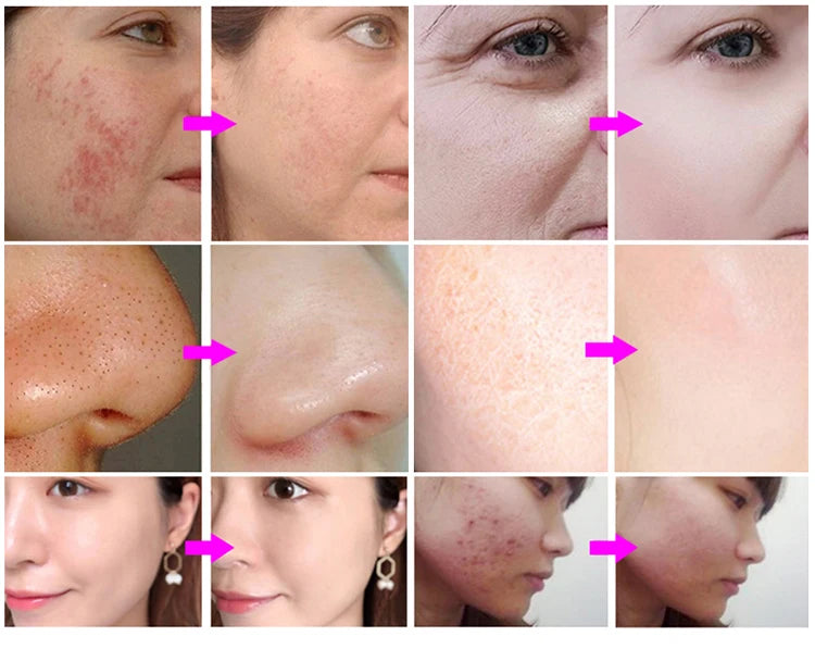 3 IN 1 Diamond Microdermabrasion hydra diamond Beauty Machine Water Spray Suction Blackhead Exfoliation Face Peeling Skin Tools