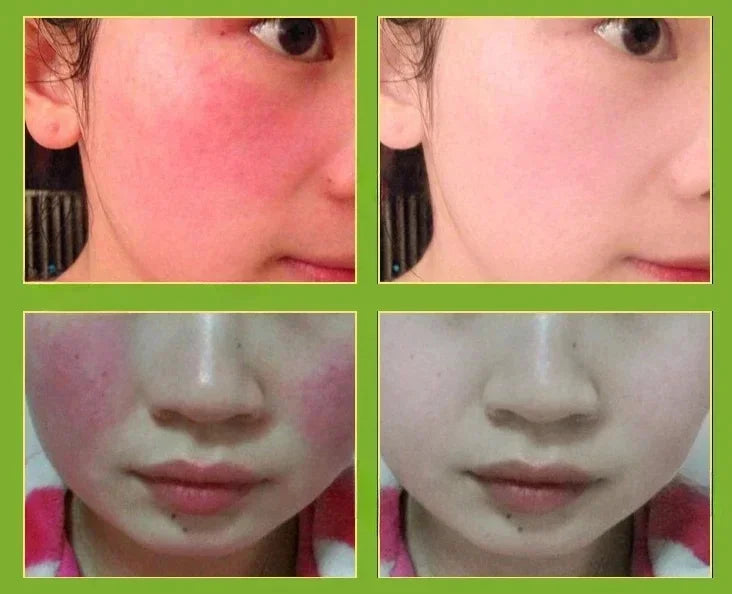 7 Day Repair Redness Serum Sooth Itching Sensitive Skin Improve Rosacea Shrink Pore Smooth Nourish Facial Skin Korean Cosmetics