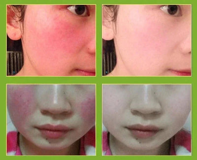 7 Day Repair Redness Serum Sooth Itching Sensitive Skin Improve Rosacea Shrink Pore Smooth Nourish Facial Skin Korean Cosmetics