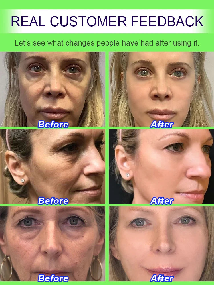 20 years younger，100% wrinkles disappear