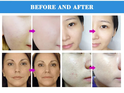 Professional Diamond Microdermabrasion Machine with Water Spray 65-68cmHg Suction Facial Exfoliation Skin Dermabrasion Machine