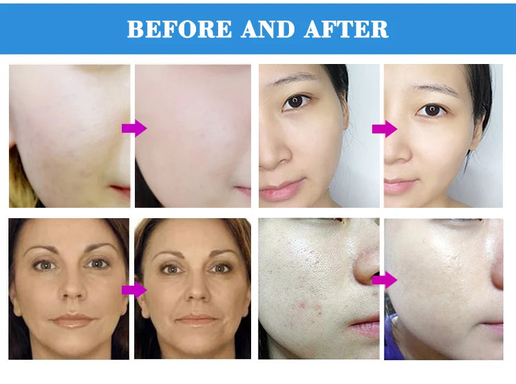 Professional Diamond Microdermabrasion Machine with Water Spray 65-68cmHg Suction Facial Exfoliation Skin Dermabrasion Machine