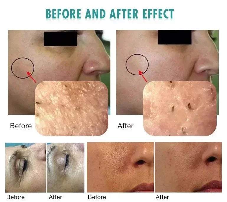 3 in 1 Hydrofacial Beauty Machine Oxygen Skin Rejuvenation Facial Tightening Machine For Skin Whitening CO2 Bubble+RF+Ultrasound