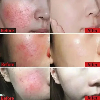Fast Repair Facial Redness Essential oil Soothing Red Blood Rosacea Improve Sensitive Skin Dryness Moisturizing Korean Cosmetics