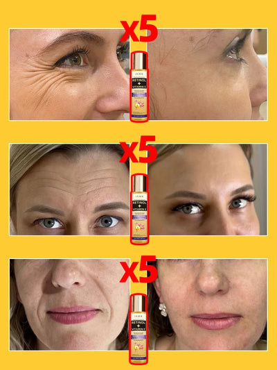 Wrinkles disappear permanently